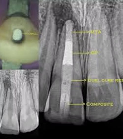 Endodontics: A Modern Overview